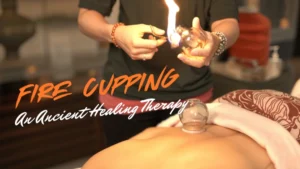 Fire Cupping: An Ancient Healing Therapy