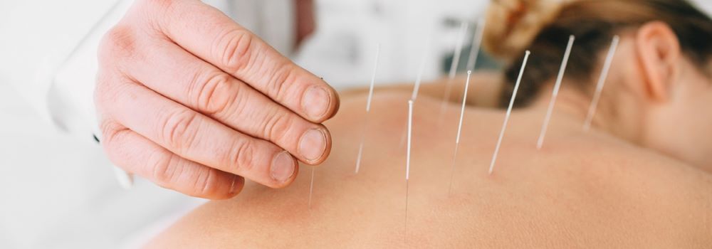 Acupuncture