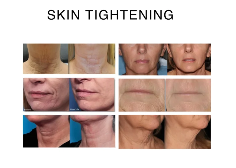 Cryo Skin Tightening
