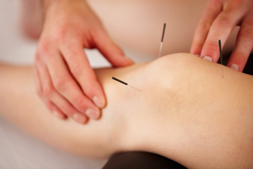 Acupuncture treatment on knee